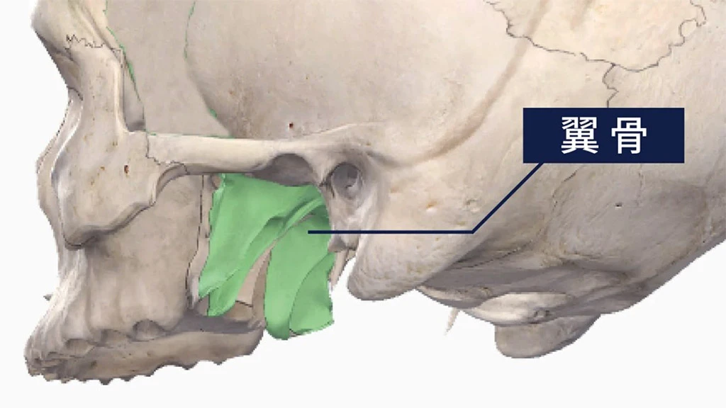 翼骨植牙 齒槽骨缺損的救星