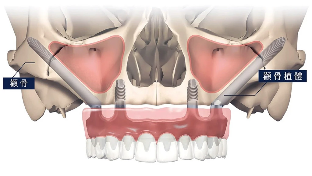 高難度顴骨植牙