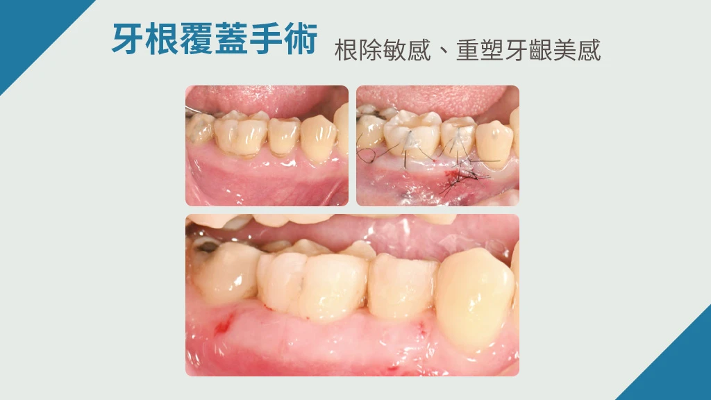台北牙周整形牙齦美學推薦