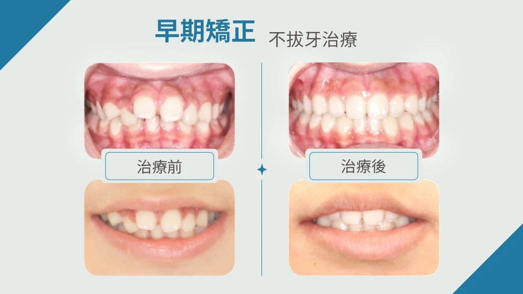 台北隱適美隱形矯正推薦