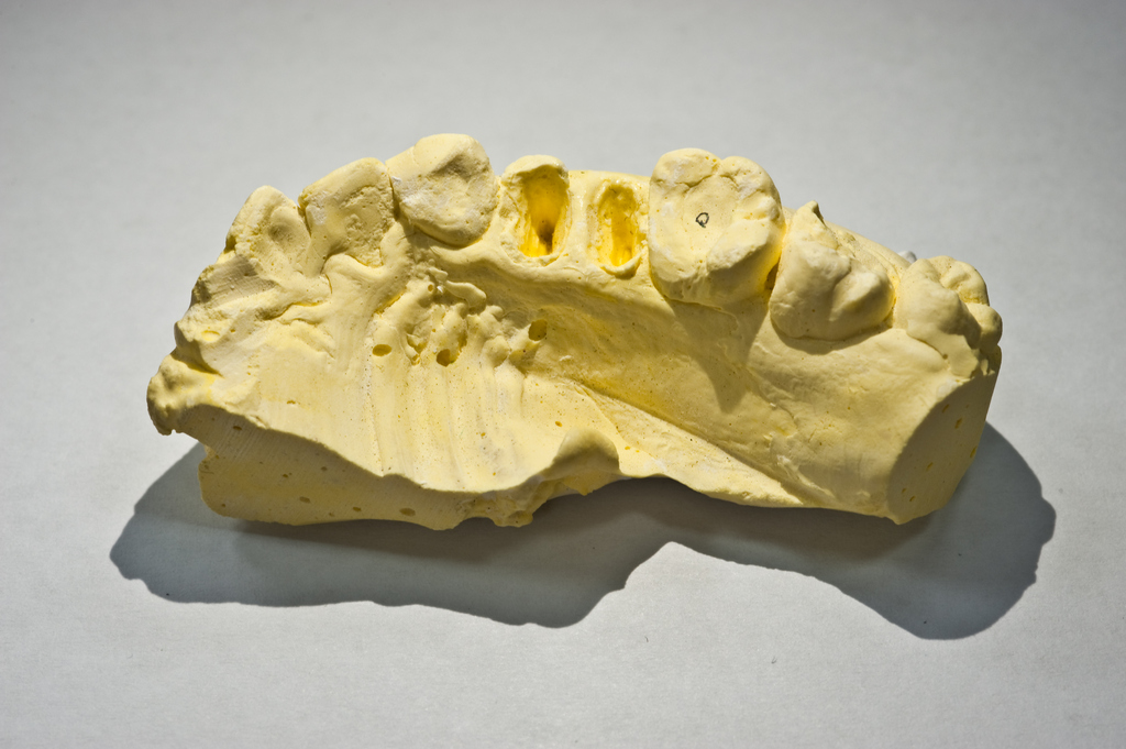 價格 齒雕,牙套 牙套,3D 銀粉,3D齒雕 樹脂,齒雕 缺點,3D 缺點,3D 3D齒雕,費用 銀粉,費用 牙套,3D齒雕 牙套