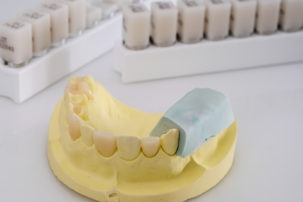 假牙選擇之全瓷牙QA特輯：材質是什麼？壽命與保固長度？