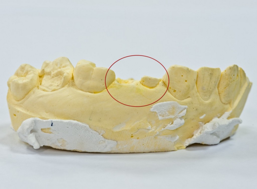 缺點 價格,3D齒雕 銀粉,銀粉 銀粉,費用 3D齒雕,3D齒雕 樹脂,缺點 齒雕,牙套 費用,費用 缺點,3D齒雕 牙套,3D齒雕 費用